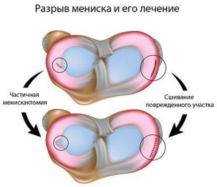 Tumor a térd alatt hátulról vagy előtte a duzzanat és fájdalom - az életem