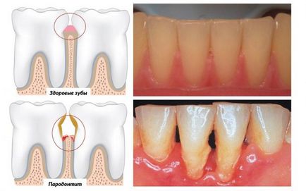 Periodontitis és a periodontális betegség ellentétben, amit ezek a betegségek (periodontitis) Periodontitis és a fogágybetegség ellentétben azzal, amit ezek a betegségek