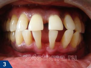 Periodontitis és a periodontális betegség ellentétben, amit ezek a betegségek (periodontitis) Periodontitis és a fogágybetegség ellentétben azzal, amit ezek a betegségek