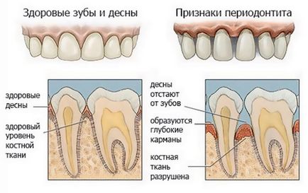 fogat periodontiíissei akut, krónikus okai, tünetei, diagnózisa, kezelése periodontitis