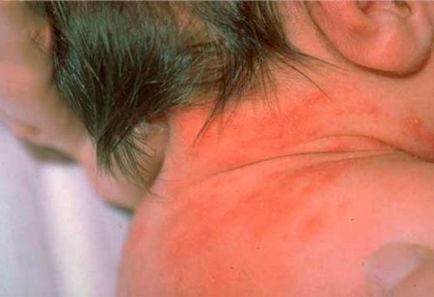 Sudamen vagy allergia hogyan lehet megkülönböztetni a gyermekek és felnőttek, fotók