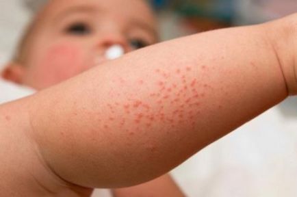 Sudamen vagy allergia hogyan lehet megkülönböztetni a gyermekek és felnőttek, fotók