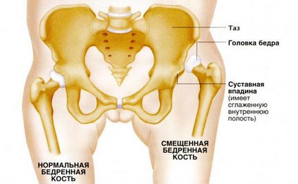 A csípőízület kopása - Okok és tünetek