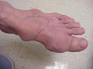Rheumatoid arthritis Foot Causes, tünetek és kezelés