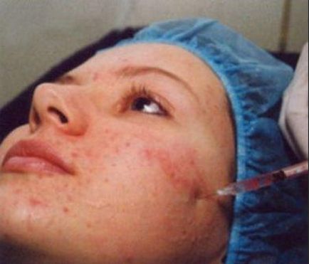 Scars a pattanások az arcodon, hogyan lehet eltávolítani őket végleg