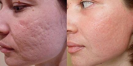 Scars a pattanások az arcodon, hogyan lehet eltávolítani őket végleg