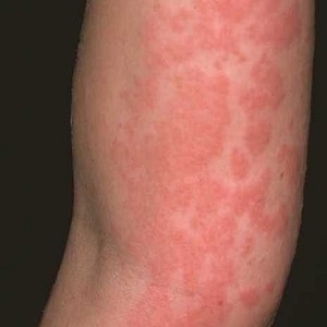 Tünetei allergia napraforgómag - szól allergia