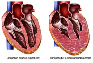 Tünetek és jelek a sör szívbetegség diagnosztizálására
