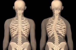 Terjedelme mellkasi és ágyéki scoliosis és fotó scoliosis 1., 2., 3. és 4. szakaszában, a hadsereg