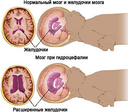 Az intracranialis nyomás tünetei csecsemőkben