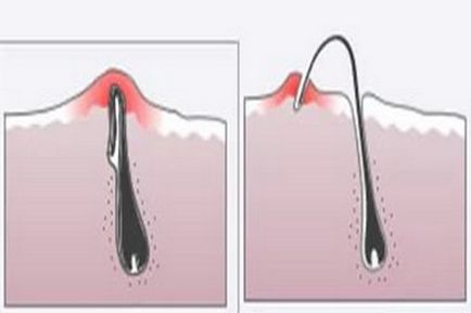 Benőtt szőrszál borotválkozás után, hogy megszabaduljon a haj növekedését és ezért a bőr a láb, az arc és a terület