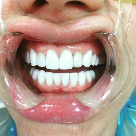 Művészi (esztétikai) helyreállítása a fogak Moszkva - helyreállítani fog megfizethető áron