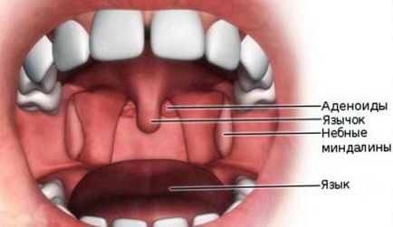 Язичок в горлі як лікувати запалення (набряк), що робити якщо болить і розпух