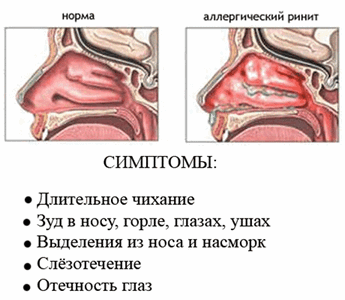 Hátsó rhinitis gyermekek, kezelése, tünetei és okai