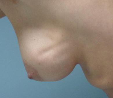Cseréje, az implantátum eltávolítása mammoplasty ismételt műveletek folynak az okok