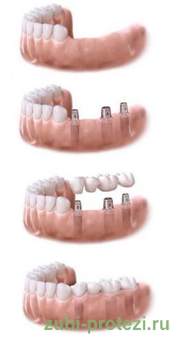 A fogászati ​​híd vagy protézis implantátum típusok 2-3 vagy több fogra