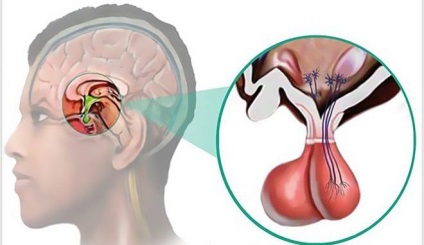 A hipofízis adenoma kialakulása, tünetei és kezelése