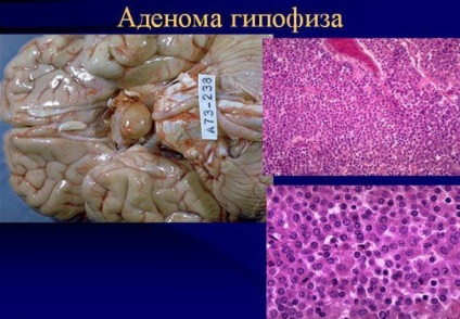 A hipofízis adenoma - tumor tünetek a nők és a kezelés hatását (hipofízis) A hipofízis adenoma - tumor tünetek a nők és a kezelés hatásainak