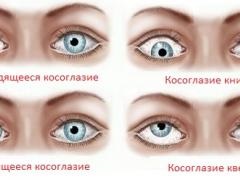 Váltakozó kancsal gyermekek és felnőttek, különösen a kezelés (váltakozva) Váltakozó kancsal gyermekek és felnőttek, különösen a kezelés