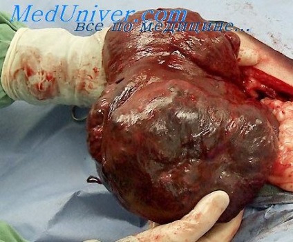 Anaplasia rosszindulatú daganatok (anaplasia) anaplasia rák