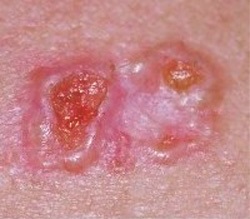 A bazális sejtes karcinóma, a bőr az arcon és a test - fénykép és kezelési módszerek, gyógyászati helyén (cryosurgery) Bazálsejtes karcinóma a bőr, az arc és a test - fotó és kezelési módszerek, az orvosi oldalon