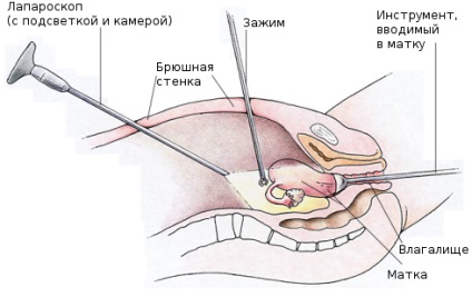 Terhesség után laparoszkópia, endometriózis