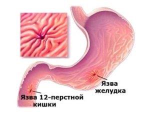 Ne vegye a hadsereg a gyomorfekély és nyombélfekély