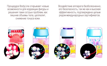 Bodyline Moszkva, árak és vélemény - klinika lantán (zsírleszívás kavitációs ajándékutalvány krioterápia Biorevitalization hardver kozmetológiai fogyás fogyókúra nélkül nem műtéti zsírleszívás cellulit kezelés nem sebészeti arc lift termolifting) Bodyline Moszkva, árak és vélemény - klinika lantán