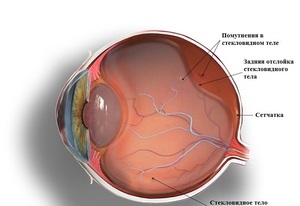 A veszélyes úszó okozza a homályos szemek, tünetei és kezelése