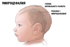 Cytomegalovirus az újszülöttek kezelt fertőzés (fertőzés) A citomegalovírus csecsemők kezelt