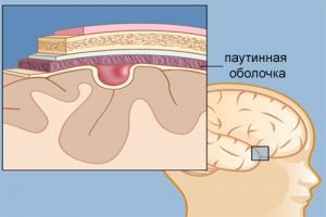 A citomegalovírus csecsemőknél kezelt (forma citomegalovírus fertőzés) A citomegalovírus csecsemők kezelt