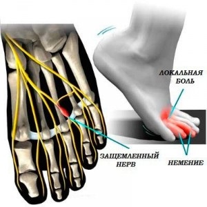 Diagnosztizálására és kezelésére Morton Neuroma