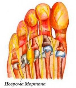 Diagnosztizálására és kezelésére Morton Neuroma