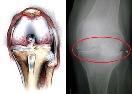 Diagnosztizálására és kezelésére osteophytes