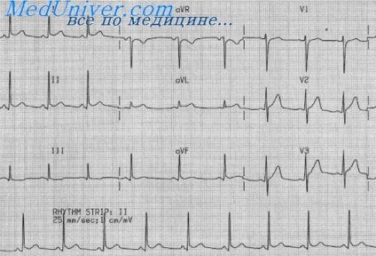 EKG szívburokgyulladás