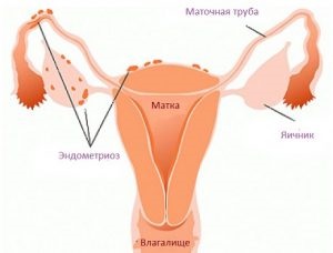 Endometriózis meddőség oka a diagnózis