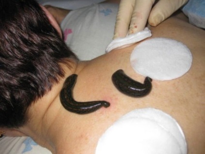 Hirudotherapy pióca terápia magas vérnyomás, egy pont-beállító áramkörhöz (girudoterapija) Hirudotherapy pióca terápia magas vérnyomás, egy pont-beállító áramkörhöz