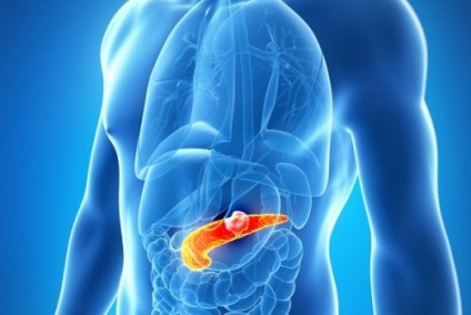 A böjt pancreatitis hogy koplalás, éhezés hasnyálmirigy-gyulladás kezelésére
