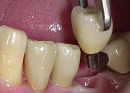 Fogászati implantátumok és élettartam-garancia (fog) Fogászati implantátumok élettartam és garancia