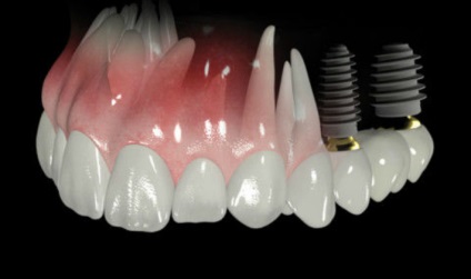 Fogászati implantátumok és élettartam-garancia (időszak) Fogászati implantátumok élettartam és garancia