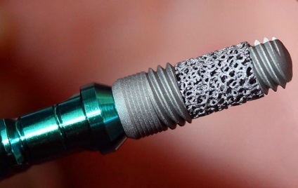 Fogászati implantátumok és élettartam-garancia (jótállás) Fogászati implantátumok élettartam és garancia