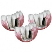 Az implantátumok astra tech (Astra Tech) implantátumok Svédország (aster) Az implantátumok astra tech (Astra Tech) implantátumok Svéd