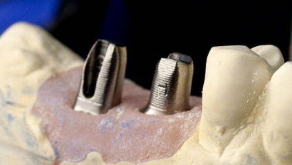 Az implantátumok astra tech (Astra Tech) implantátumok Svédország (astra) Az implantátumok astra tech (Astra Tech) implantátumok Svéd