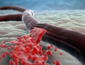 Stroke tüneteinek férfiakban és elsősegély (stroke) Stroke tüneteinek a férfiak és elsősegély