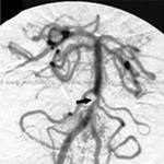 Ischaemiás stroke-ot (szélütés haemorheologiai típus) ischaemiás stroke