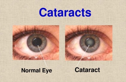 cataract szürkehályog kezelésére a cukorbetegség)