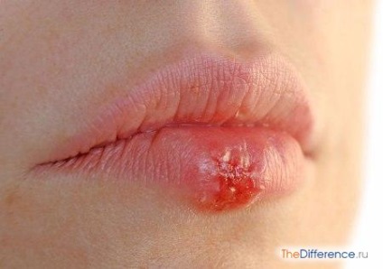 Hogyan lehet megkülönböztetni a herpesz hideg az ajkak