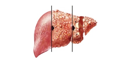 Hogyan hal meg a májzsugorodás tünetek a halál előtt