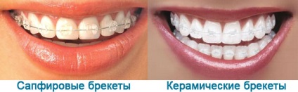 Hogyan kiegyenesedik a fogak