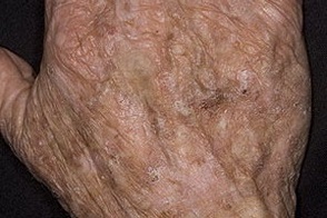 Keratosis bőr okozza, tünetei, kezelés otthon, sprosidermatologa